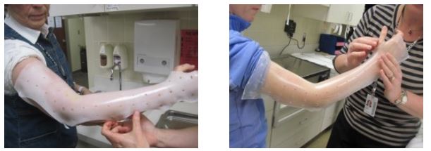 circumferential-elbow-splint